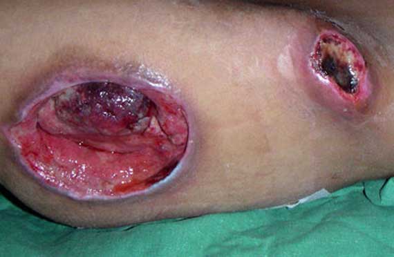 Stage IV Pressure Ulcer Stage IV Pressure Ulcer