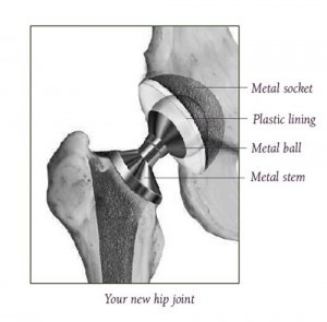 Your New Artificial Hip Joint