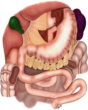 Roux-en-Y Gastric Bypass