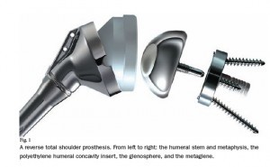 Reverse shoulder replacement prosthesis