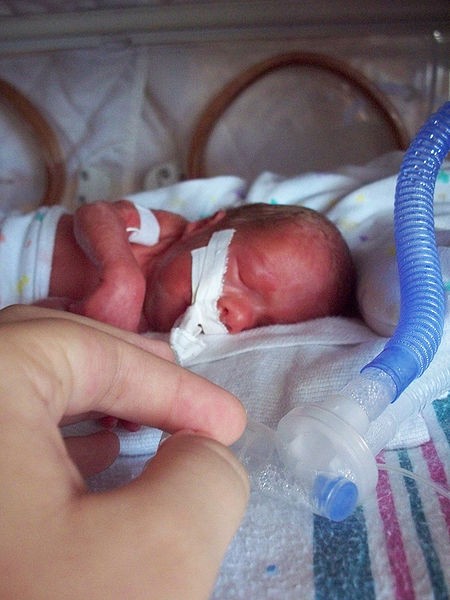 An intubated premature baby girl born prematurely at 26 weeks 6 days gestation. 