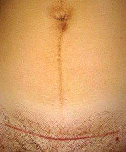 Low transverse cesarean scar 