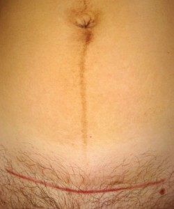 Low transverse cesarean scar 