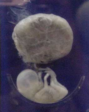 Fetus at 12 weeks with placenta 