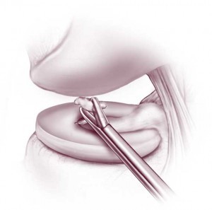 Removal of lose body from the joint space