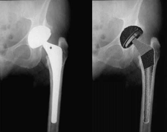 X-ray of hip replacement to make sure it is in position (Left). Illustration of how implant looks in place. (Right)