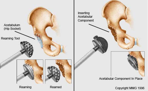 Acetabulum reamed and component put in place.