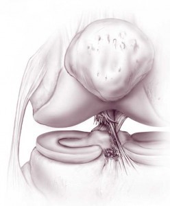 Anterior Cruciate Ligament Tear Anterior Cruciate Ligament Tear
