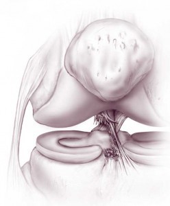 Anterior Cruciate Ligament Tear