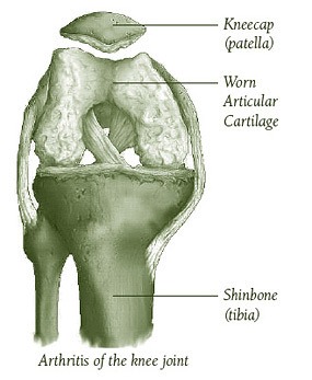 Arthritic knee joint
