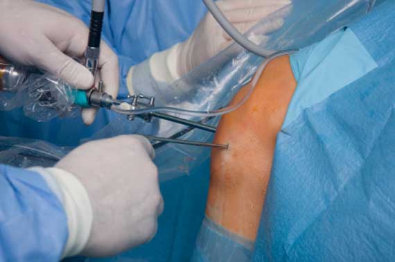 Knee arthroscopy