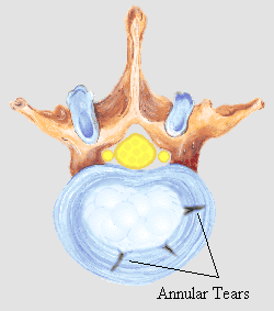 Annular Tears in vertebral disk