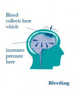 Non-traumatic bleeding brain injury
