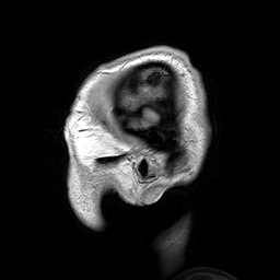 MRI of the brain