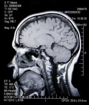 brain-mri