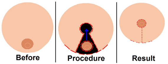 Breast reduction illustration