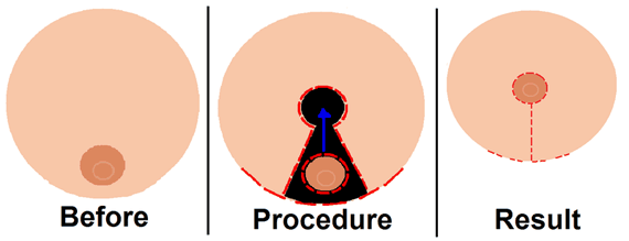 Breast reduction illustration Breast reduction illustration