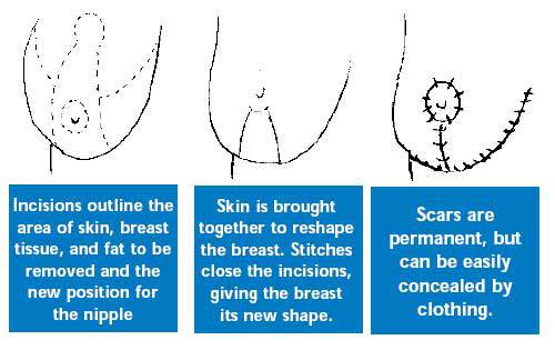 Breast reduction incisions