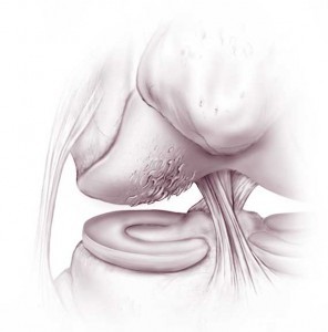 Cartilage defects Cartilage defects