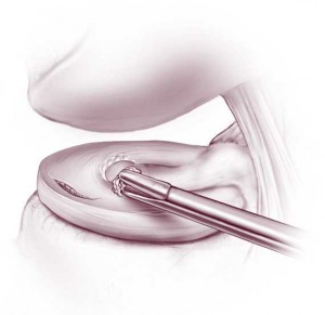 Cartilage removal Cartilage removal