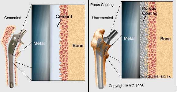 Cemented and Uncemented Prosthesis