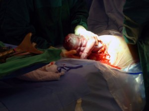 Cesarean birth with low transverse incisio