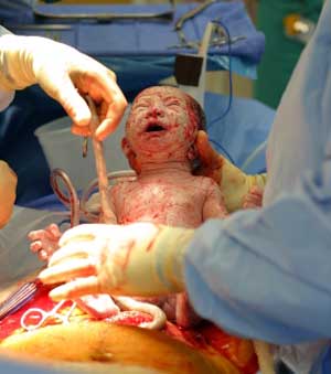 Baby being born by cesarean