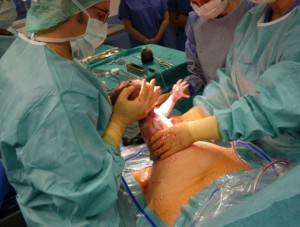 Pulling out baby during cesarean section