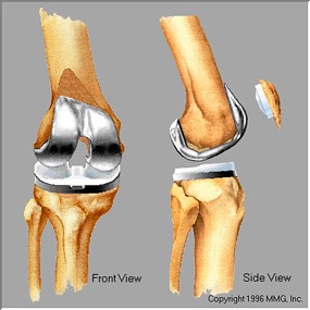 Completed knee replacement