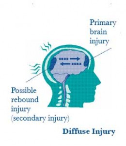 Diffuse traumatic brain injury