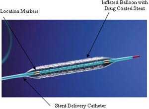 Drug eluting stent Drug eluting stent