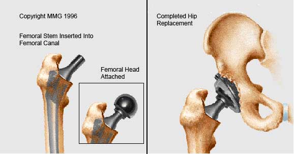 Femoral Stem Inserted, Completed Hip Replacement