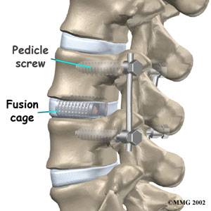 Fusion cage