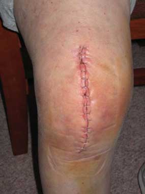 Knee replacement incision closed with staples