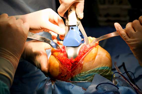 Knee replacement surgery