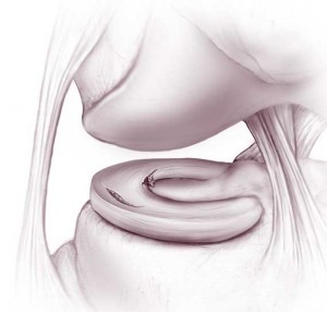 Meniscal tears