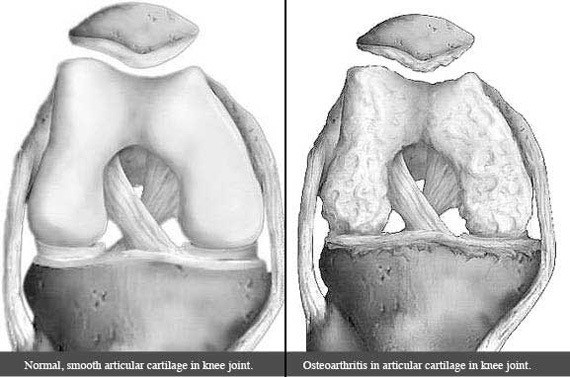 Normal Knee Articular Cartilage and Osteoarthritic Knee Articular Cartilage
