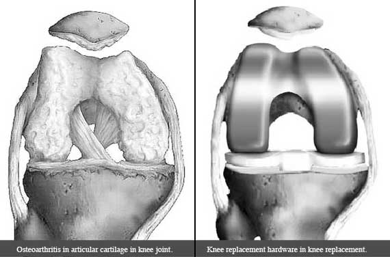 Osteoarthritic Knee and Knee Replacement Hardware