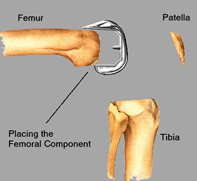 Placing femoral component on prepared femur