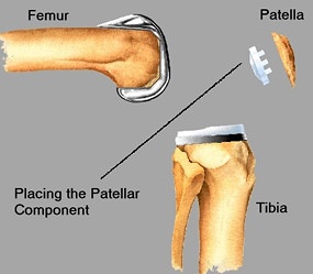 Placing patellar component