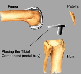 Placing the tibial component - metal tray