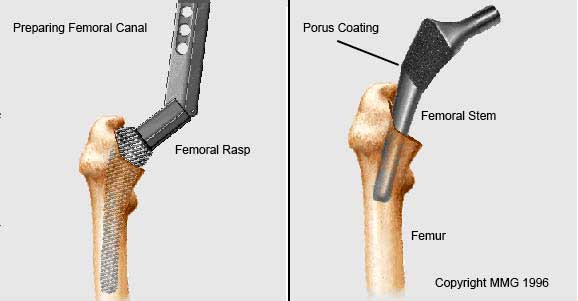 Preparing Femoral Canal, Inserting Femoral Stem