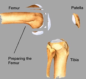 Preparing the femur