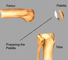 Preparing the Patella (kneecap)