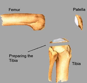 Preparing the tibia