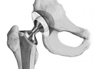 Prosthetic hip joint