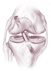 Reconstructed ACL Reconstructed ACL