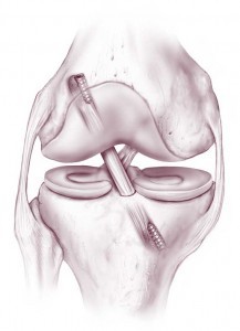 Reconstructed ACL