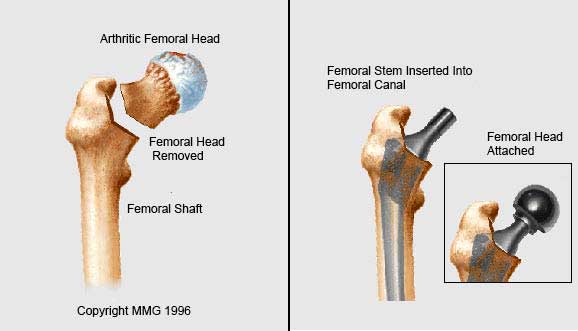 Removal of femoral head.