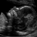 Ultrasound at 14 weeks.